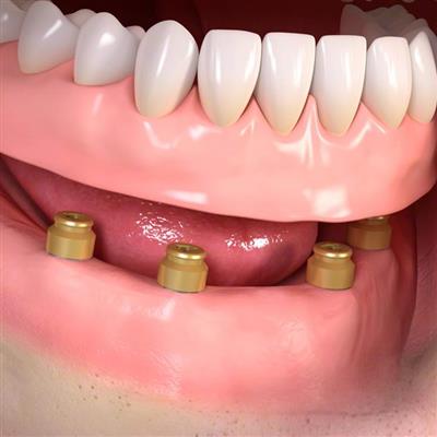 Fixed Dentures Vs Implants . Learn Which Is The Best Replacement Teeth We Explain The Pros And Cons Of Denture Implants Vs Fixed Bridge Teeth.