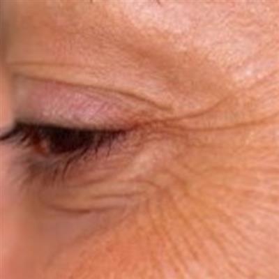 Anti-wrinkle treatments