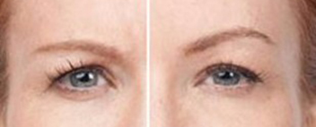 brow lifting