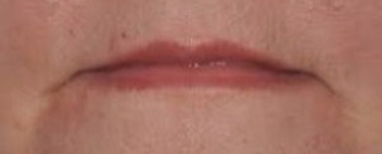 mouth corners